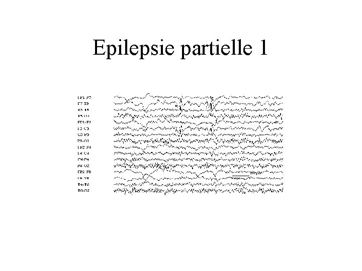 Epilepsie partielle 1 