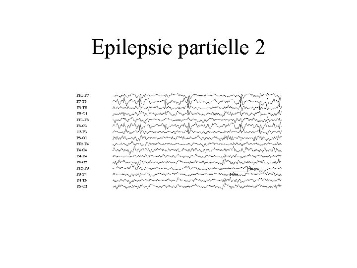 Epilepsie partielle 2 