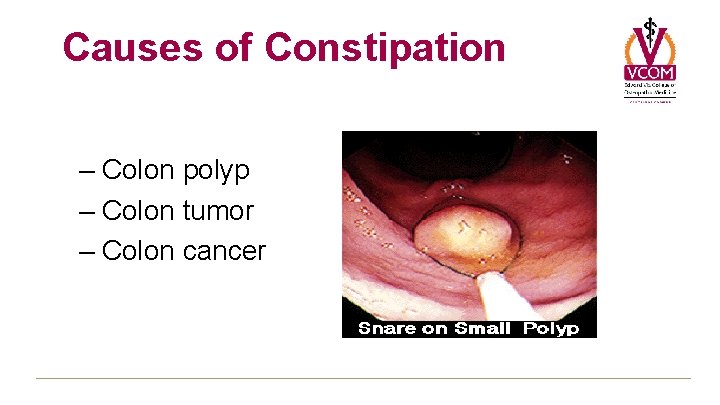 Causes of Constipation – Colon polyp – Colon tumor – Colon cancer Causes of Constipation – Colon polyp – Colon tumor – Colon cancer