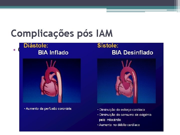 Complicações pós IAM • Choque cardiogênico 