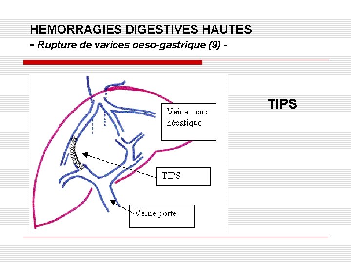 HEMORRAGIES DIGESTIVES HAUTES - Rupture de varices oeso-gastrique (9) - TIPS 