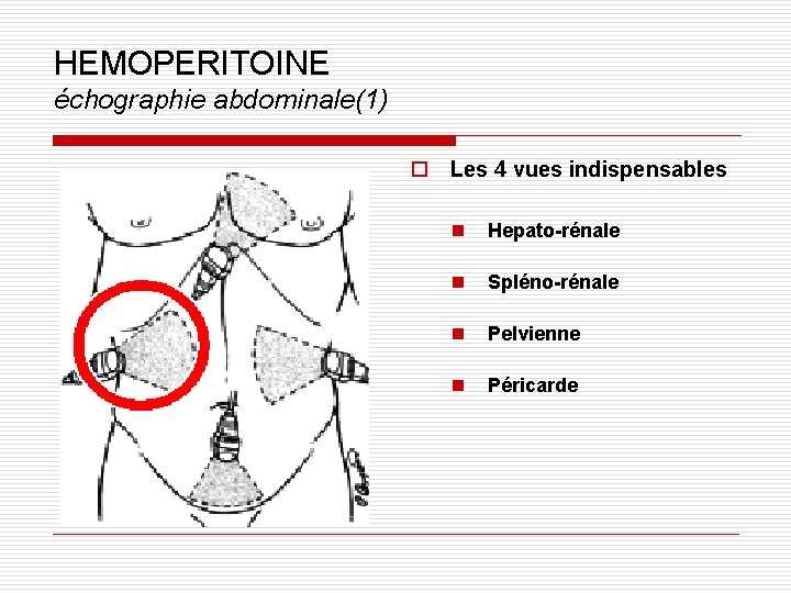 HEMOPERITOINE échographie abdominale(1) o Les 4 vues indispensables n Hepato-rénale n Spléno-rénale n Pelvienne