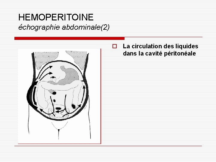 HEMOPERITOINE échographie abdominale(2) o La circulation des liquides dans la cavité péritonéale 