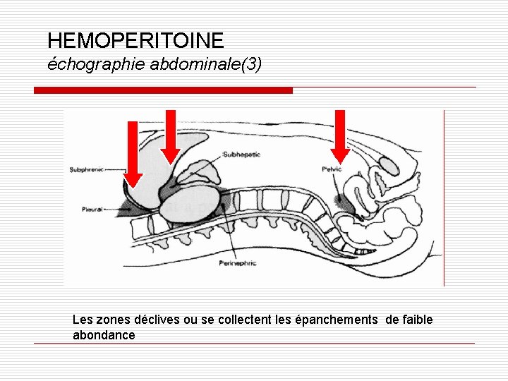 HEMOPERITOINE échographie abdominale(3) Les zones déclives ou se collectent les épanchements de faible abondance