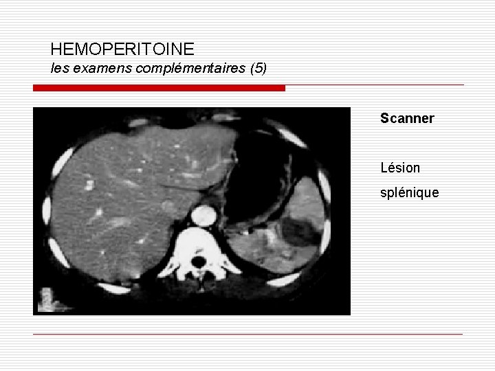 HEMOPERITOINE les examens complémentaires (5) Scanner Lésion splénique 