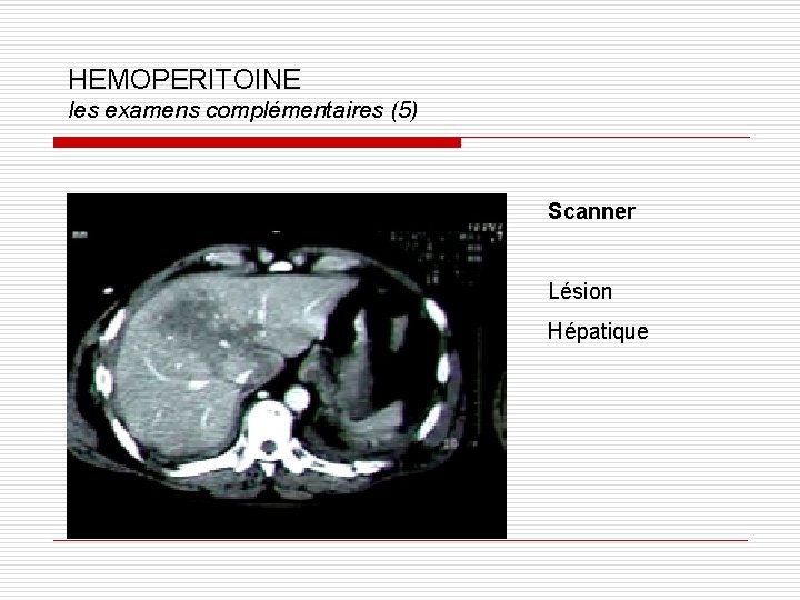 HEMOPERITOINE les examens complémentaires (5) Scanner Lésion Hépatique 