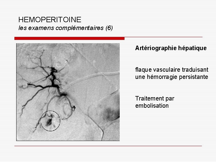 HEMOPERITOINE les examens complémentaires (6) Artériographie hépatique flaque vasculaire traduisant une hémorragie persistante Traitement