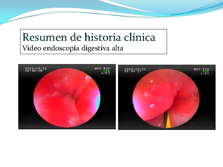 Resumen de historia clínica Video endoscopía digestiva alta 