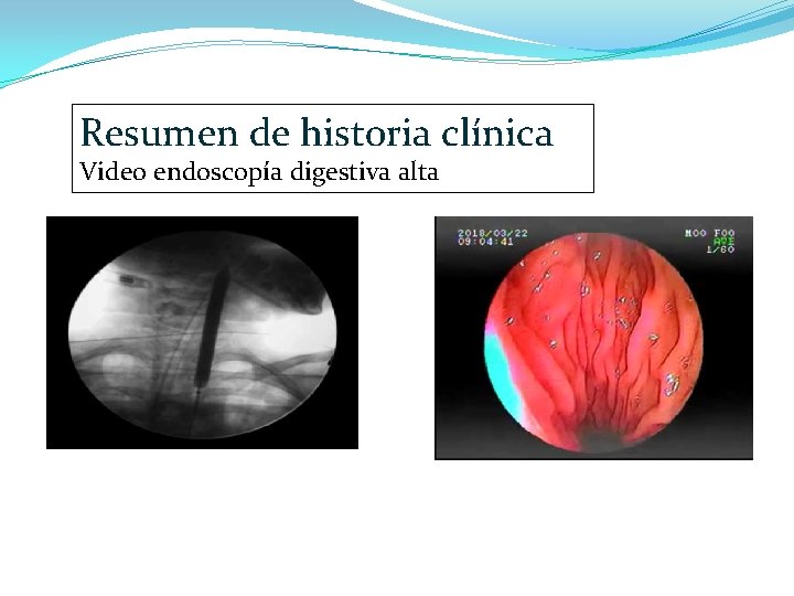 Resumen de historia clínica Video endoscopía digestiva alta 