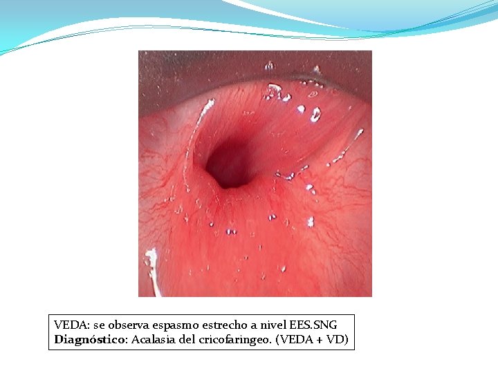 VEDA: se observa espasmo estrecho a nivel EES. SNG Diagnóstico: Acalasia del cricofaringeo. (VEDA