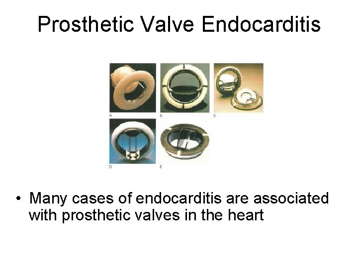 Prosthetic Valve Endocarditis • Many cases of endocarditis are associated with prosthetic valves in Prosthetic Valve Endocarditis • Many cases of endocarditis are associated with prosthetic valves in