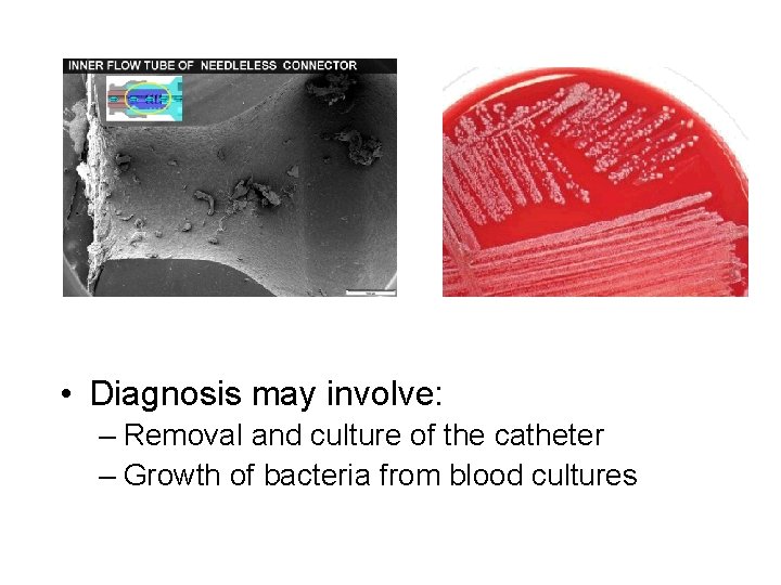  • Diagnosis may involve: – Removal and culture of the catheter – Growth