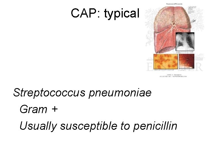 CAP: typical Streptococcus pneumoniae Gram + Usually susceptible to penicillin 