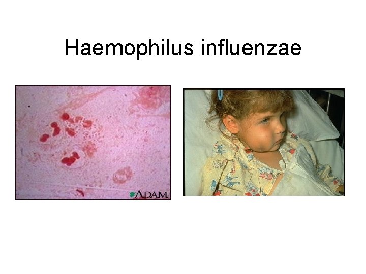 Haemophilus influenzae 