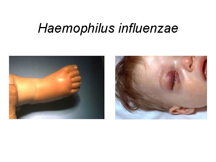 Haemophilus influenzae Haemophilus influenzae