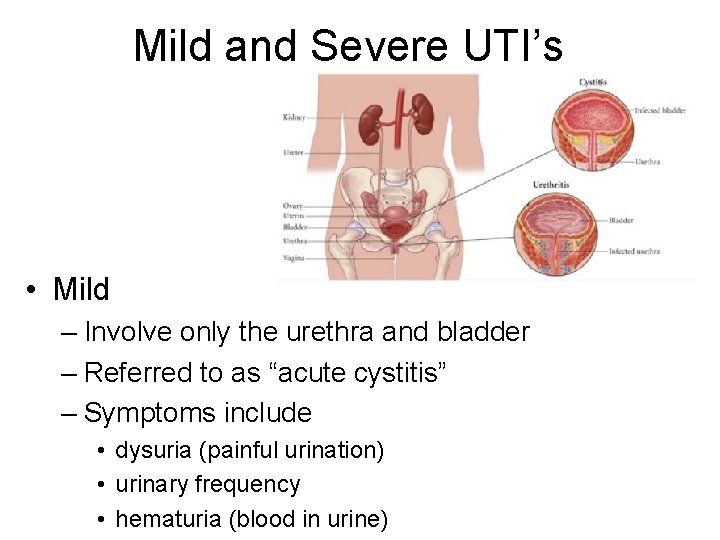 Mild and Severe UTI’s • Mild – Involve only the urethra and bladder –