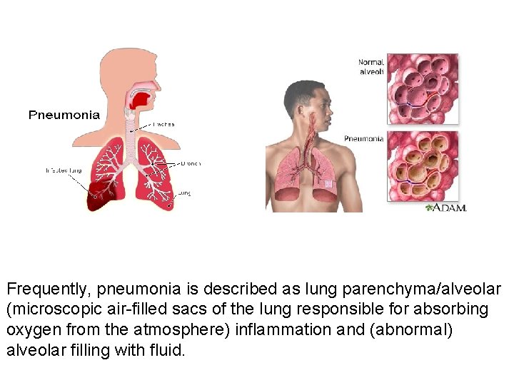 Frequently, pneumonia is described as lung parenchyma/alveolar (microscopic air-filled sacs of the lung responsible