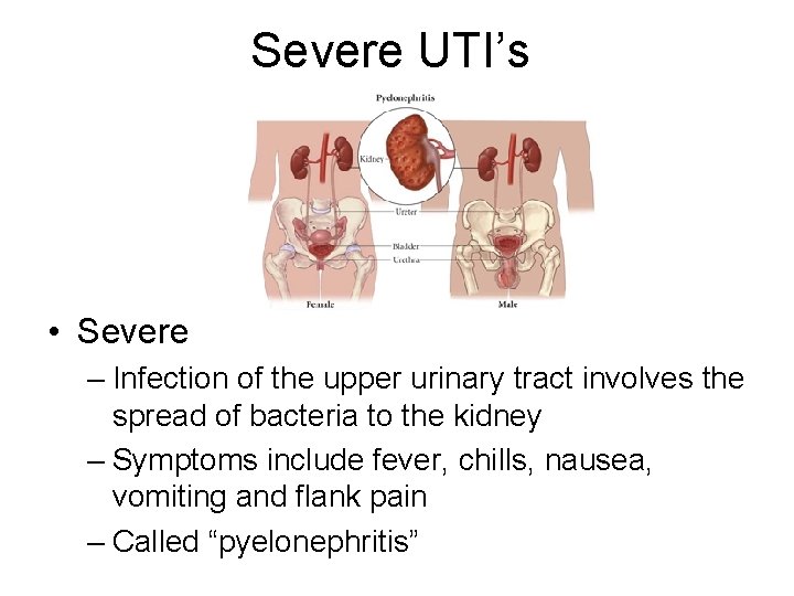 Severe UTI’s • Severe – Infection of the upper urinary tract involves the spread Severe UTI’s • Severe – Infection of the upper urinary tract involves the spread