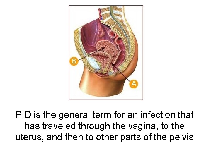 PID is the general term for an infection that has traveled through the vagina,