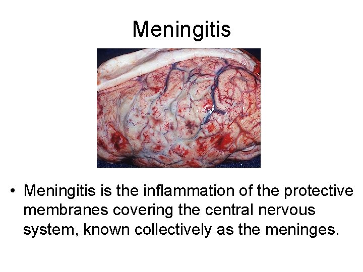 Meningitis • Meningitis is the inflammation of the protective membranes covering the central nervous