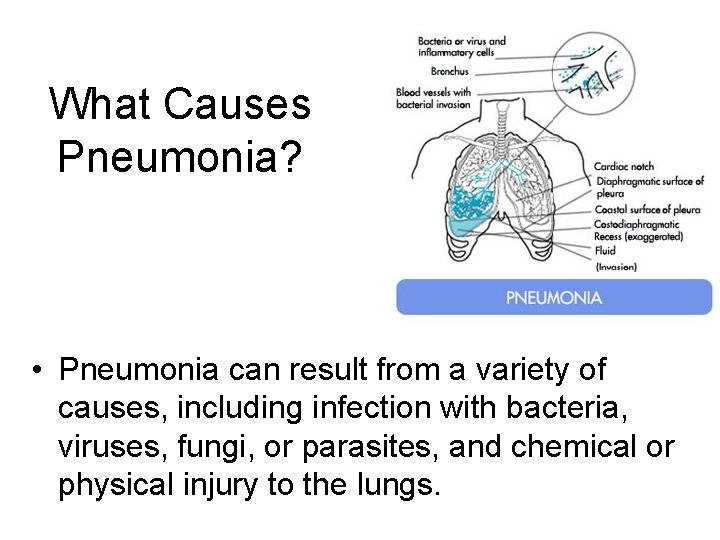 What Causes Pneumonia? • Pneumonia can result from a variety of causes, including infection