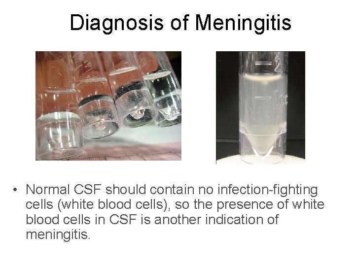 Diagnosis of Meningitis • Normal CSF should contain no infection-fighting cells (white blood cells),