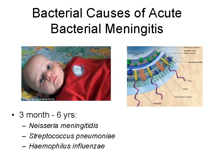 Bacterial Causes of Acute Bacterial Meningitis • 3 month - 6 yrs: – Neisseria