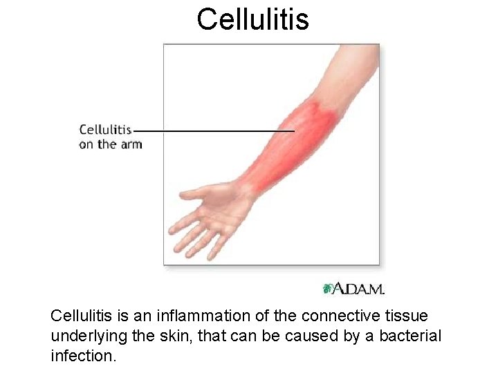 Cellulitis is an inflammation of the connective tissue underlying the skin, that can be Cellulitis is an inflammation of the connective tissue underlying the skin, that can be