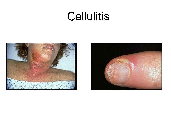 Cellulitis Cellulitis