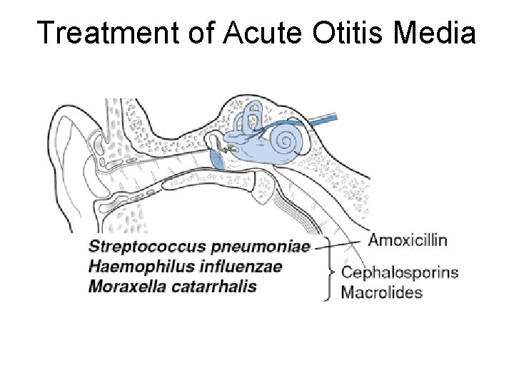 Treatment of Acute Otitis Media Treatment of Acute Otitis Media