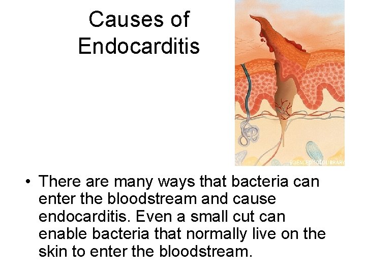 Causes of Endocarditis • There are many ways that bacteria can enter the bloodstream Causes of Endocarditis • There are many ways that bacteria can enter the bloodstream