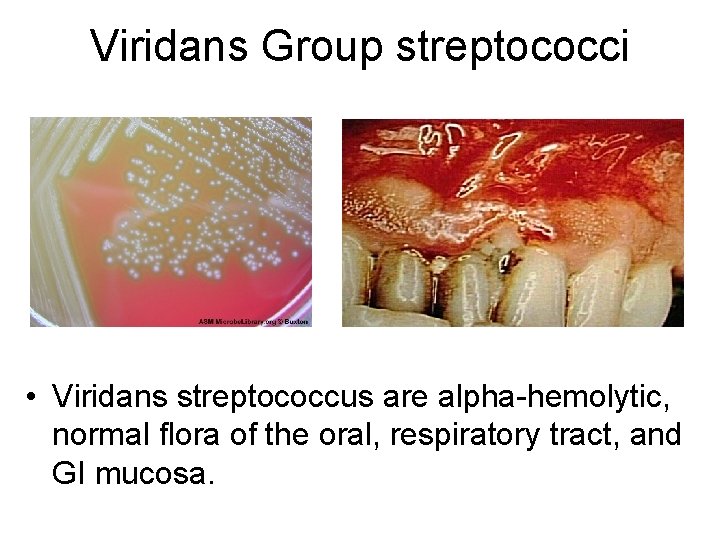 Viridans Group streptococci • Viridans streptococcus are alpha-hemolytic, normal flora of the oral, respiratory