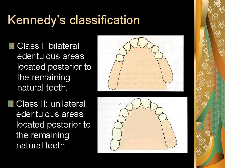 Kennedy’s classification Class I: bilateral edentulous areas located posterior to the remaining natural teeth.