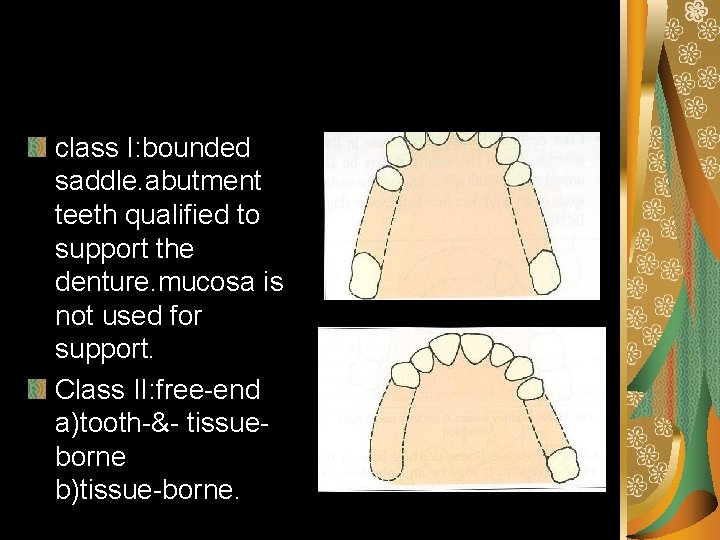 class I: bounded saddle. abutment teeth qualified to support the denture. mucosa is not