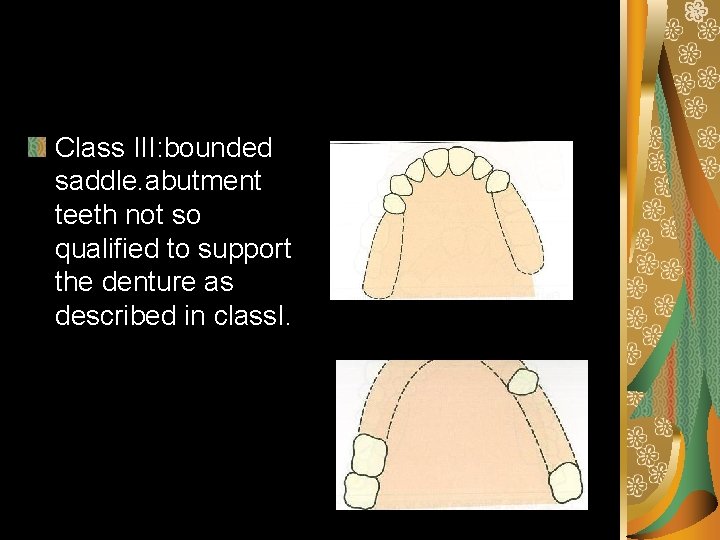 Class III: bounded saddle. abutment teeth not so qualified to support the denture as