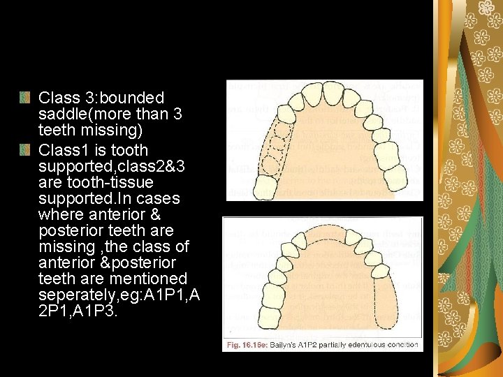 Class 3: bounded saddle(more than 3 teeth missing) Class 1 is tooth supported, class