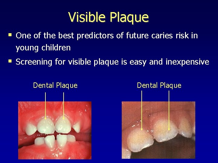 Visible Plaque § One of the best predictors of future caries risk in young