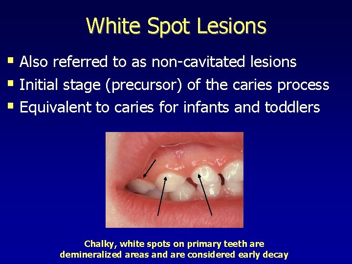 White Spot Lesions § Also referred to as non-cavitated lesions § Initial stage (precursor)