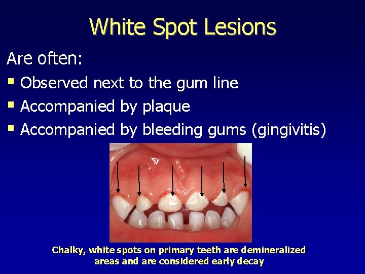 White Spot Lesions Are often: § Observed next to the gum line § Accompanied