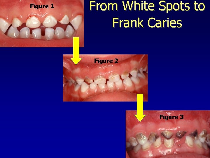 Figure 1 From White Spots to Frank Caries Figure 2 Figure 3 