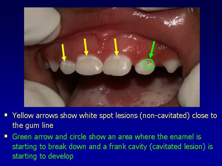 § Yellow arrows show white spot lesions (non-cavitated) close to the gum line §