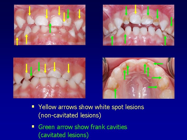 § Yellow arrows show white spot lesions (non-cavitated lesions) § Green arrow show frank