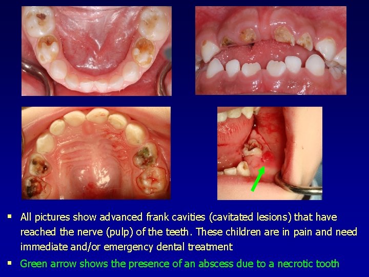 § All pictures show advanced frank cavities (cavitated lesions) that have reached the nerve