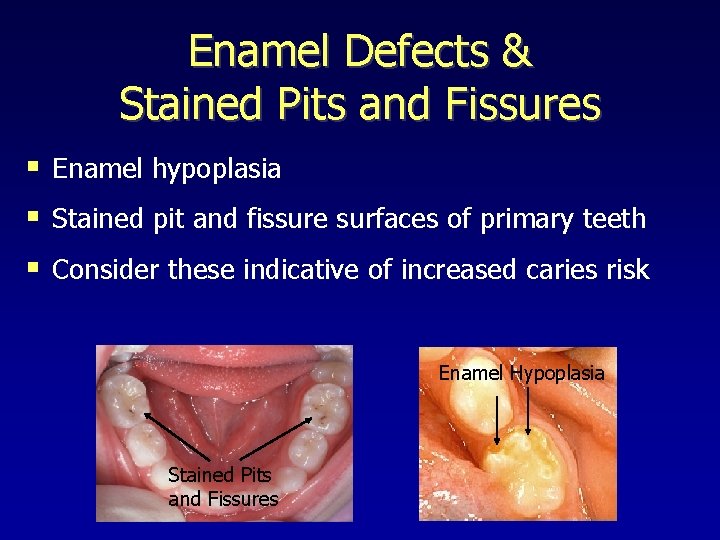 Enamel Defects & Stained Pits and Fissures § Enamel hypoplasia § Stained pit and