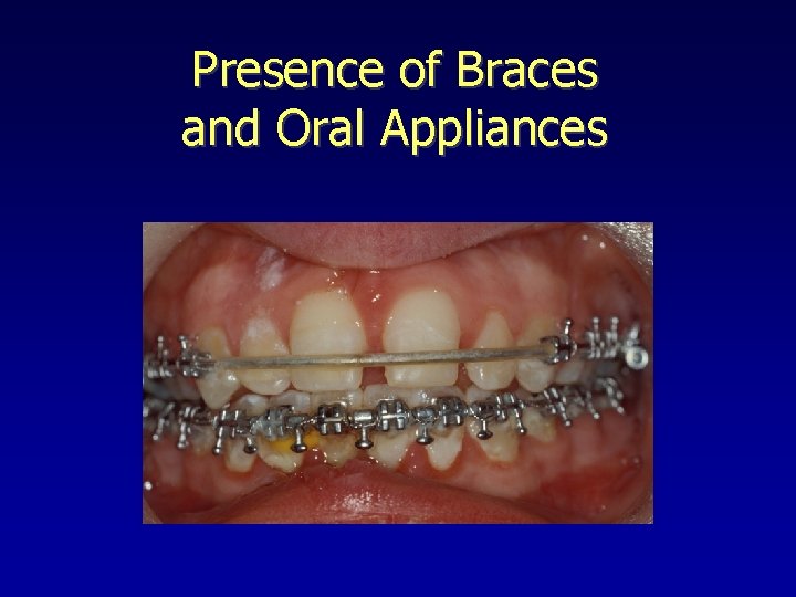 Presence of Braces and Oral Appliances 