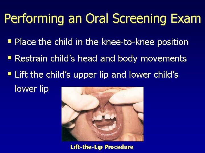 Performing an Oral Screening Exam § Place the child in the knee-to-knee position §