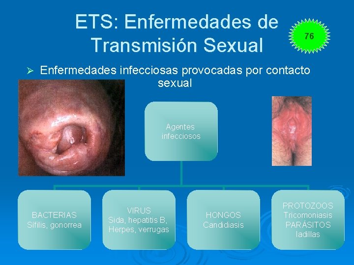 ETS: Enfermedades de Transmisión Sexual Ø 76 Enfermedades infecciosas provocadas por contacto sexual Agentes