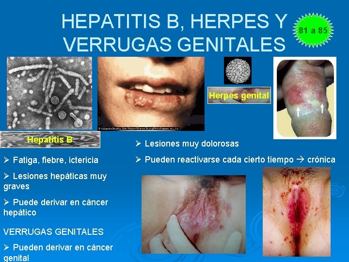 HEPATITIS B, HERPES Y VERRUGAS GENITALES 81 a 85 Herpes genital Hepatitis B Ø