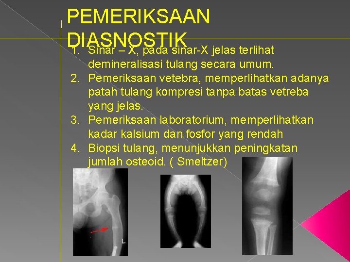 PEMERIKSAAN DIASNOSTIK 1. Sinar – X, pada sinar X jelas terlihat demineralisasi tulang secara