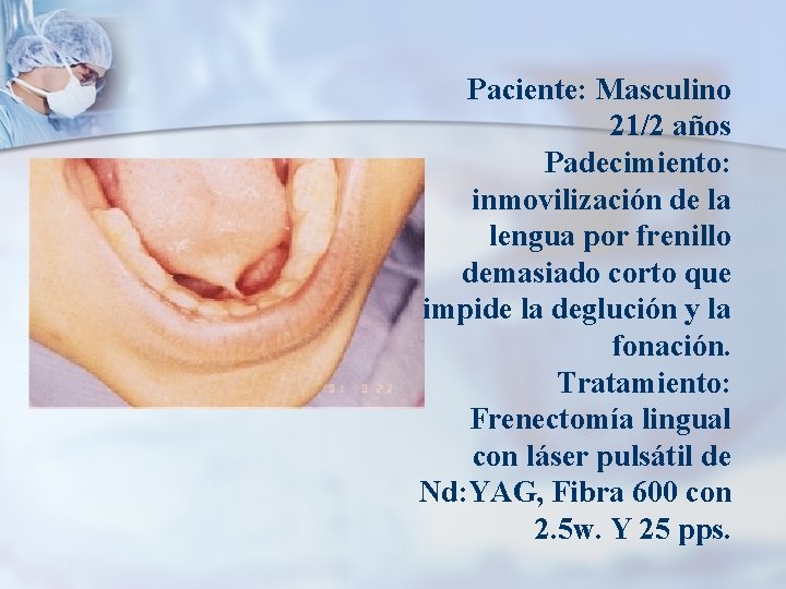 Paciente: Masculino 21/2 años Padecimiento: inmovilización de la lengua por frenillo demasiado corto que